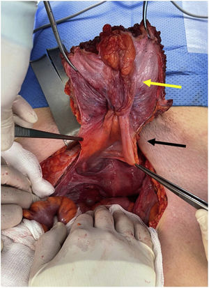 Intraoperative image revealing the tumor lesion (yellow arrow) dependent in the urachus (black arrow), which invades both anterior rectus muscles, while the bladder is macroscopically free.