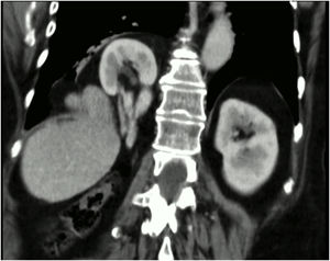 CT image showing a large right diaphragmatic hernia.