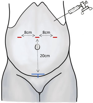 Port positioning for the rTAPP, after installation of the pneumoperitoneum with the Veres needle. Red markings: skin incisions; blue markings: symphysis (target organ for bilateral rTAPP).