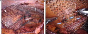 Mesh positioning and fixation. (a) Mesh is fixed from medial to lateral to (1) Cooper's ligament, (2) the fascia of the rectus abdominis muscle, (3) the transversus abdominis muscle, and (4) to the iliac fascia. (b) Detail of fixation of mesh to the iliac fascia, passing the needle with the nerves left out (blue arrows).