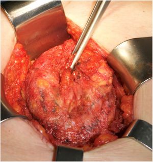 Hernia recurrence due to central mesh breakdown in a patient with retromuscular repair as index repair.