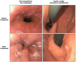 Stretta. GEJ before and after treatment. Radiofrequency treatment for gastroesophageal reflux disease. George Triadafilopoulos M. UpToDate.