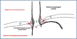Pathophysiology of gastro-oesophageal reflux. 1. Lower oesophageal sphincter (transient weakness/relaxation disturbance). 2. Oesophagogastric junction. 3. Phreno-oesophageal ligament. 4. Angle of His. 5. Diaphragm.