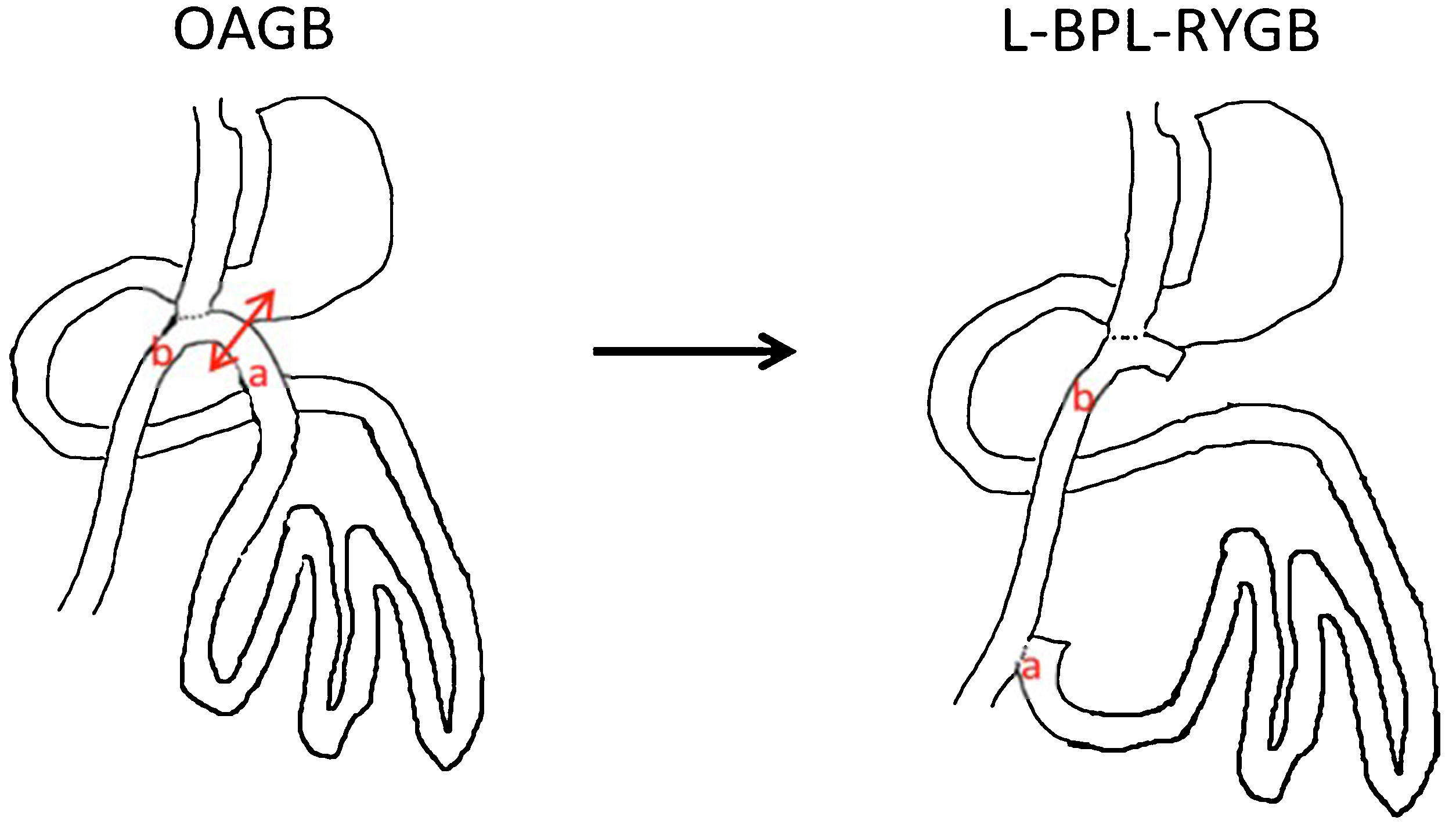 bile-reflux-after-bariatric-surgery-cirug-a-espa-ola-english-edition