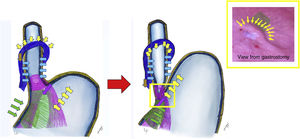 Swallowing sequence and anti-reflux valve. View from gastrostomy (flap valve).