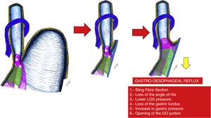 Loss of the valve mechanism as a consequence of the resection of the vertical gastrectomy.