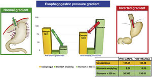 Inversion of the oesophagogastric gradient in vertical gastrectomy.