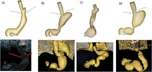 Illustration and 3D reconstruction of complications related to the appearance of gastro-oesophageal reflux disease in sleeve gastrectomy. A) Intrathoracic slip. B) Dilation of the gastric fundus and oesophagus. C) Torsion. D) Stenosis/narrowing of the incisura angularis. In all cases slipping of the sleeve is seen.