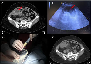 Abscessed IAM: (A) diagnostic CT scan; (B) ultrasound image to guide percutaneous needle aspiration; (C) ultrasound-guided percutaneous needle aspiration and collection of pus; (D) CT image 15 days after antibiotic/percutaneous treatment.