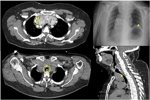 Several manifestations of compression syndrome caused by the endothoracic goiter: collapse of the superior vena cava; elevated left hemidiaphragm due to paralysis of the left phrenic nerve; and critical tracheal stenosis.