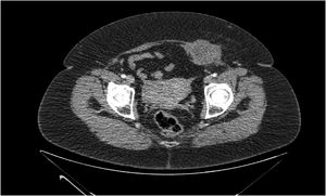 Abdominal CT with contrast.
