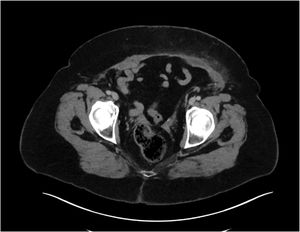 Follow-up CT scan.