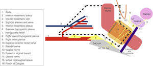 Diagram of the dissection plane of the near-total mesorectal excision (black dashed line) used in the Near-TME laparoscopic approach. The vesical nerve is observed with a nerve trunk that rapidly divides into 2 branches: the vaginal nerve, which innervates the uterus and vagina; and the superior rectal nerve, which innervates the upper part of the anterior surface of the rectum. The posterior vaginal branch leads to the posterior vaginal wall, whose branches cross the rectovaginal septum and are distributed to the anterior rectal wall.