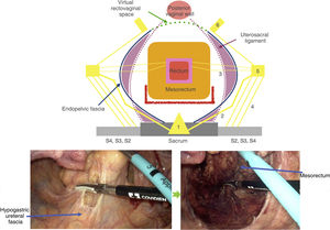 Posterior laparoscopic dissection plane of the near-total mesorectal excision (red line) in the Near-TME approach; access to the posterior presacral space to the mesorectal fascia.