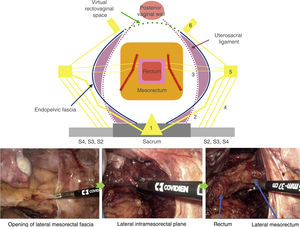 Lateral laparoscopic dissection plane of the near-total mesorectal excision (red line) in the Near-TME approach.