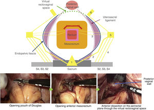 Anterior laparoscopic dissection place of the near-total mesorectal excision (red line) in the Near-TME approach.