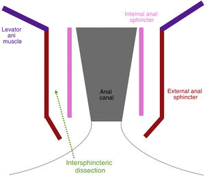 Schematic diagram of the intersphincteric dissection of the perineal approach of the Near-TME.