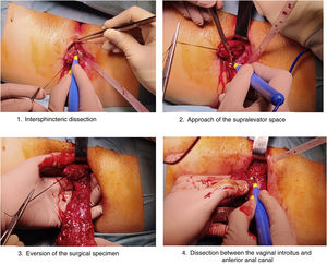 Perineal proctectomy approach.