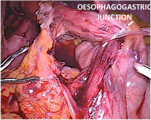 Extensive dissection of the OGJ.