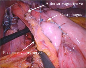 Fundoplication between the vagal trunks and the oesophagus.
