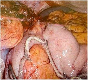 Surgical part (on the right of the image) and plasty (on the left of the image), with a short junction (no longer than 3 cm).