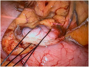 Application of two silk stitches to the distal end of the surgical part.