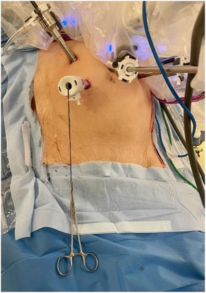 Removal of the two silk stitches by abdominal accessory trocar.