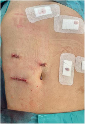 Closure of the small laparotomy used for the removal of the surgical specimen.