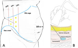 Location of infiltration points as described by Tomás Ibarra6 (A) and ultrasound administration of type A toxin in the lateral abdominal muscles (B).