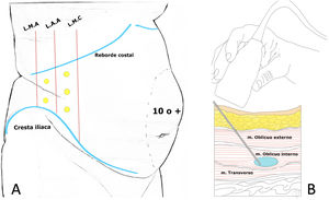 Proposed indications for prehabilitation in abdominal wall pathology with botulinum toxin type A (BTA) and/or progressive pneumoperitoneum (PPP). * Herniated Volume Percentage or Tanaka Index = Hernia Sac Volume (cm3)/Abdominal Cavity Volume (cm3).9.