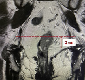 Coronal T2-weighted view of magnetic resonance imaging (MRI) showing a rectal tumour and its relationship with the sphincters and puborectalis muscle (red dotted line). Tumours to be included in the study should have an extension of no more than 3 cm and their lower limit should not exceed the dashed line shown in the figure.