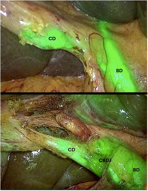 View of the BD, CD and CBDJ with ICG before (top) and after (bottom) dissection of Calot