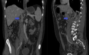 CT scan: Right renal agenesis, and absence of subhepatic and intrahepatic inferior vena cava (IVC). Dilated infrahepatic IVC with thrombosis extending to both iliac and femoral veins.