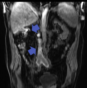 MRI: Thrombosis at the level of the ilio-caval axis. Right renal agenesis and absence of intrahepatic IVC.