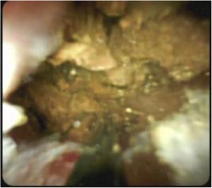 Lithotripsy for the fragmentation of choledocholithiases using an electrohydraulic probe.