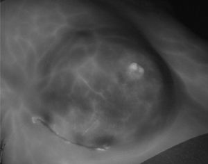 Areas of false necrosis. This patient with a nipple-sparing mastectomy and prepectoral implant has false skin hypoperfusion due to a thin skin flap. The vessels of the subdermal plexus that ensure adequate flap perfusion can be seen.