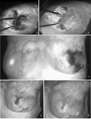 Early ischaemia with late recovery. Fig. 3a shows a woman with an extreme reduction mammoplasty who presents distal hypoperfusion in the lateral flap 30 seconds after the ICG bolus. At 140 seconds, recovery of perfusion in this area is observed (3b). Fig. 3c shows a patient with a skin- and nipple-sparing mastectomy on the left side who presents an extensive area of ​​ischaemia in the upper and lower poles of the breast that recovers two minutes after the ICG bolus (3d and 3e).