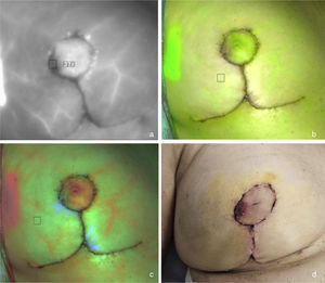 Ischaemia in the lateral area of ​​the right areola. ICG angiography identifies an area of ​​vascular distress in the lateral periphery of the right areola visible in fluorescence mode (absence of contrast; 4a), superposition mode (absence of green; 4b) and segmented fluorescence by colour (absence of red; 4c). During the postoperative period, the patient suffered superficial epidermiolysis in this area that did not require surgical intervention (4d).