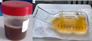 Macroscopic urine appearance.