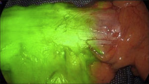 ICG-FA in left hemicolectomy (Modo SPY Overlay – Stryker 1688®).