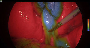 Identification of anatomical structures during laparoscopic cholecystectomy (Modo SPY CSF – Stryker 1788®).
