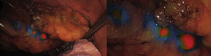 Identification of lymphadenopathies during ultra-low anterior resection; perilesional ICG administered prior to start of surgery (Modo SPY CSF – Stryker 1788®).