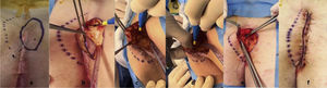 Diagram of the Karydakis technique: (A and B) lateralized incision; (C and D) preparation of the subcutaneous flap; (E) flap is advanced for suturing; (F) lateral closure at the midline. (Source: our own records).