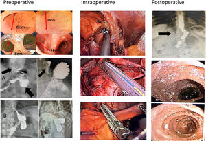 A) The endoscopic and radiological assessment determining the length of the blind loop by measuring the distance from the bottom of the blind loop to the intestinal edge of the gastrojejunostomy. B) Intraoperative images demonstrating hiatal hernia, gastric pouch downsizing and long blind loop resection. C) Postoperative radiological and endoscopic images demonstrating no hiatal hernia, small gastric pouch and no candy cane image.