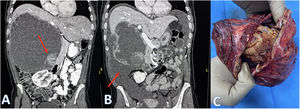(A) Initial CT scan. Arrow: solid intracystic component. (B) CT rupture: intra-abdominal free fluid arrow. (C) Surgical specimen.