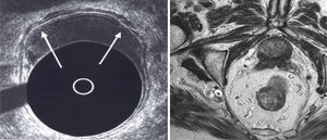 Endorectal ultrasound and MRI image of a cT1 tumour.