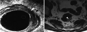 Endorectal ultrasound and MRI image of a cT2 tumour. The arrows show the muscularis propia.