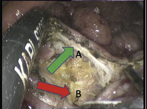 Complete wall resection. The ultrasonic scalpel is used to cut the rectal wall down to the perirectal fat. This continues in this plane just below the muscular layer (arrow A) without entering the perirectal fat (arrow B).