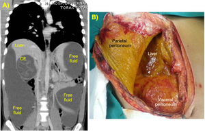 Images of a patient with ABP due to complicated CE of the liver and rupture to the peritoneum: (A) computed tomography; (B) j-shaped laparotomy (peritoneal and visceral peritoneum are impregnated with a layer of fibrin and bile).