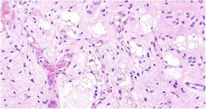 Lipoblasts in the histological section with hematoxylin-eosin stain.